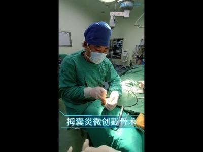 拇囊炎微创截骨术